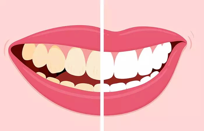 7. Stained Teeth