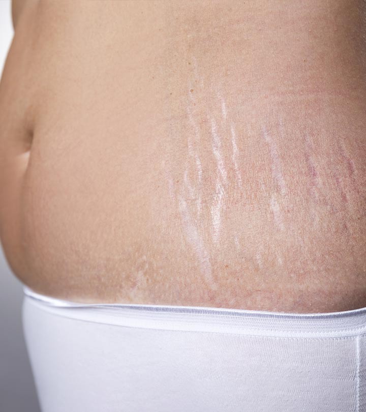 Do You The Know The Difference Between White Stretch Marks And Purple Stretch Marks