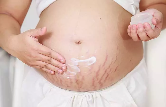 RedPurple Stretch Marks