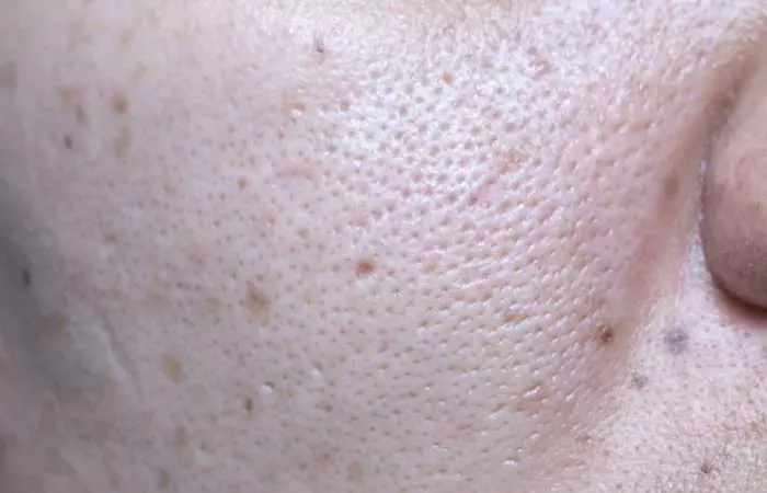 What Are Blackheads And How Do They Happen