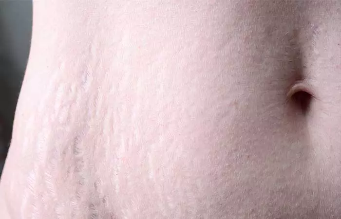 White Stretch Marks