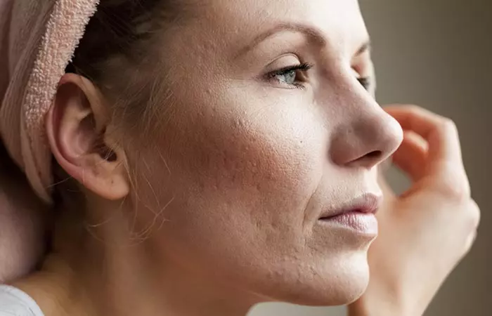 1. Clogged Pores 