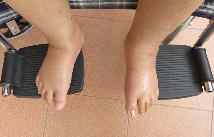 1. Fluid Retention