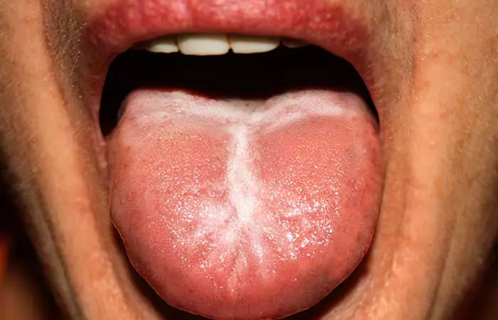 1. White Tongue Or White Coat