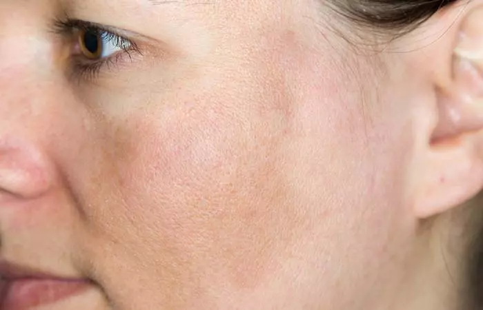 10. Facial Hyperpigmentation 