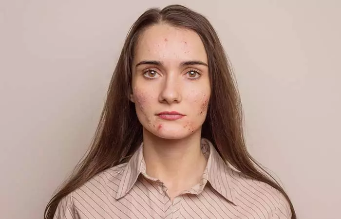 3. Skin Break Outs Or Acne