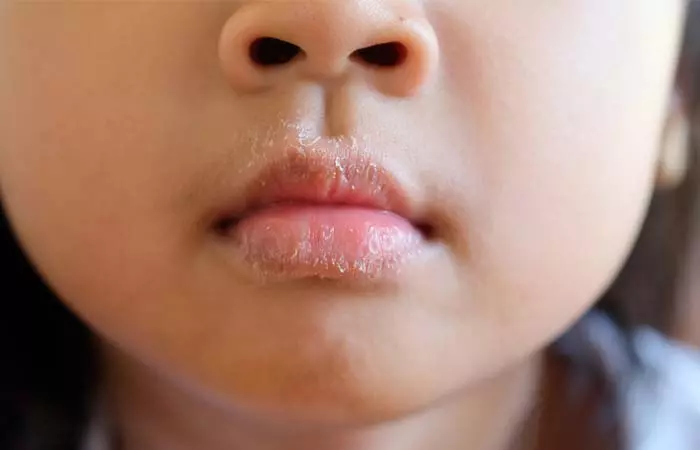 6. Skin Peeling Around Nose And Mouth 