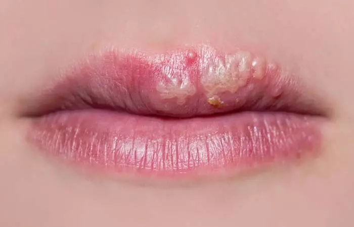 7. Cold Sores 