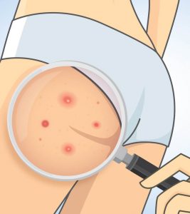 Home Remedies To Get Rid Of Butt Acne...