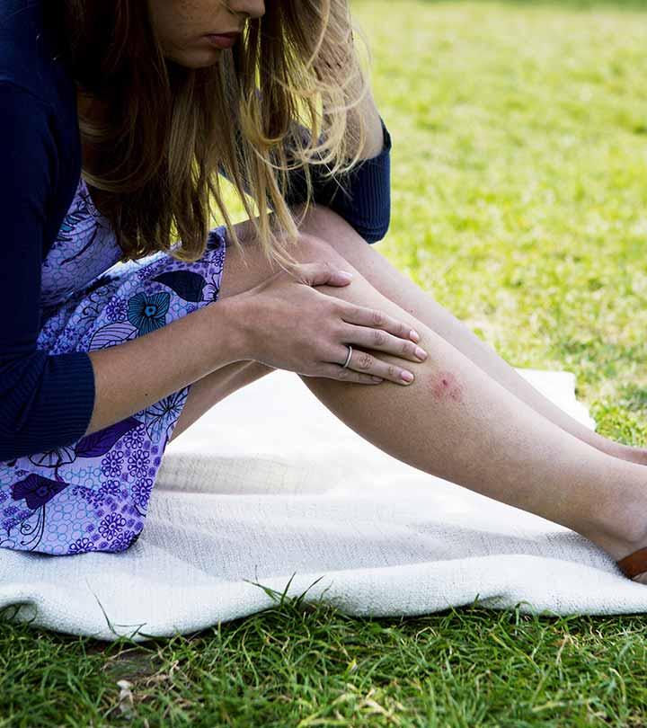 Lyme Disease – Causes, Symptoms, And Ways To Relieve The Symptoms