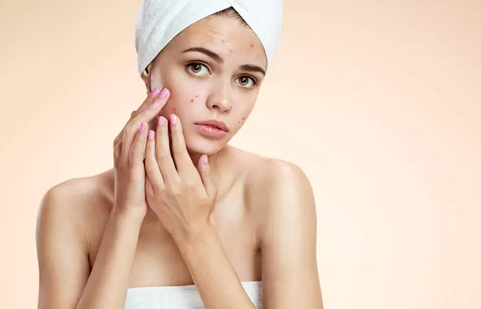 1. It Can Lead To Acne