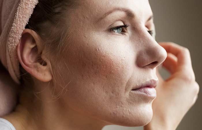 6. Acne