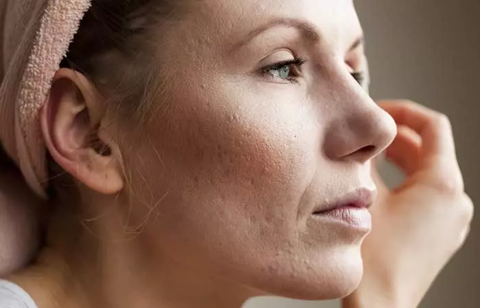 6. Acne