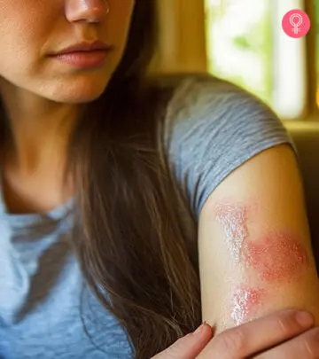 Though the rash won't disappear immediately, you can ease some discomfort right away.