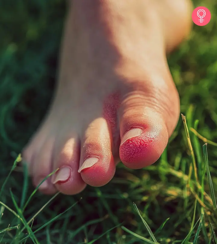 Home Remedies For Athlete’s Foot