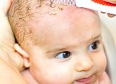 How To Get Rid Of Cradle Cap In Toddlers & Tips To Prevent It