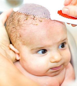 How To Get Rid Of Cradle Cap In Toddlers
