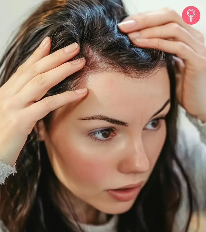 woman with scabs on scalp