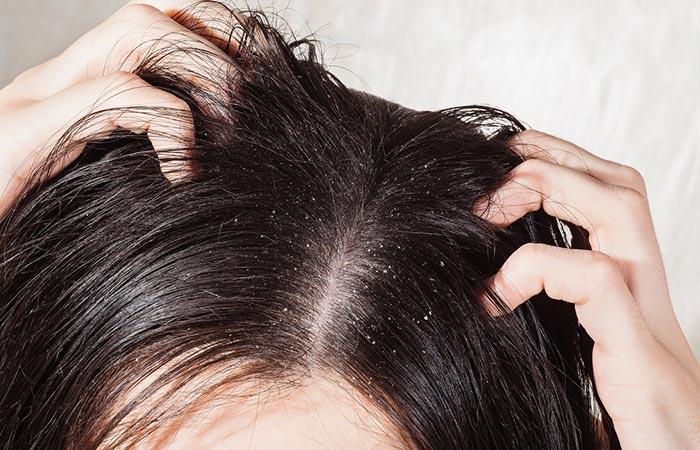 Psoriasis Vs Dandruff: Check Out What Do You Have?