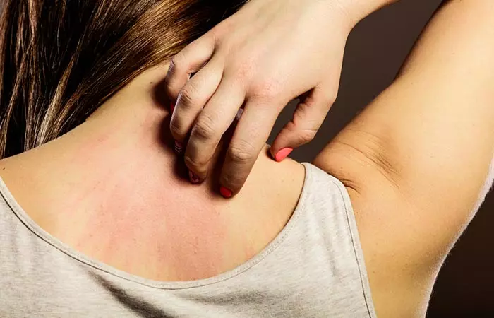 3. Itching