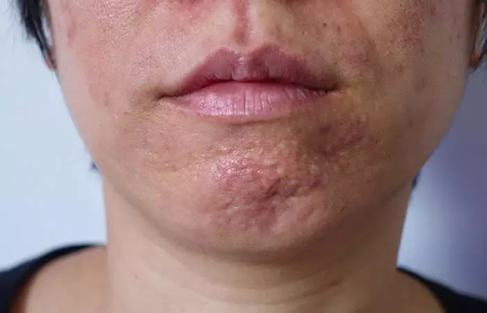 Long And Distorted Pores Due To Skin Aging