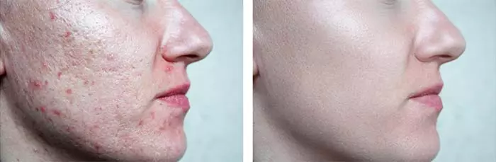 Pores Caused By Acne