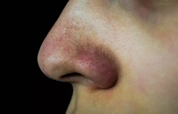 Pores Caused By Blackheads