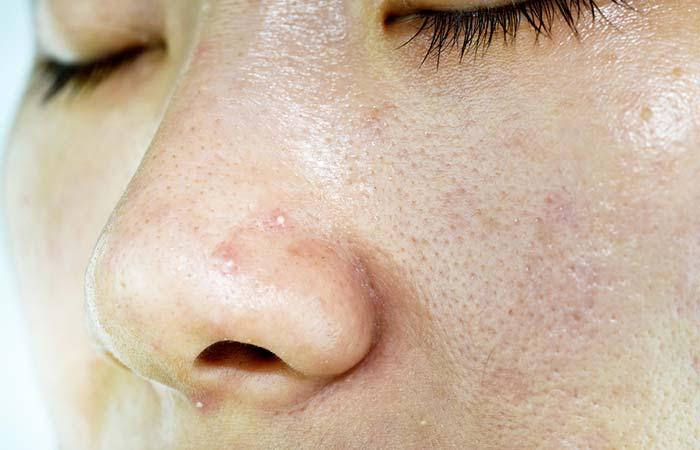 Pores Caused By Whiteheads