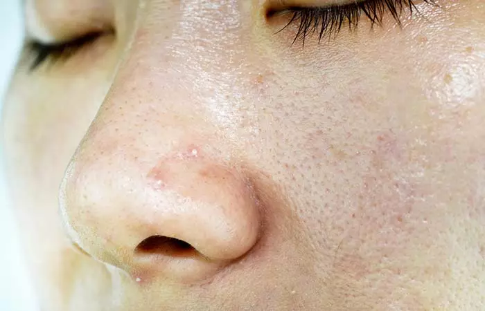 Pores Caused By Whiteheads