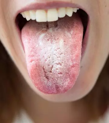 10 Ways To Get Rid Of White Tongue And Make It Healthier