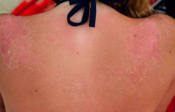 3. Blisters On Your Skin