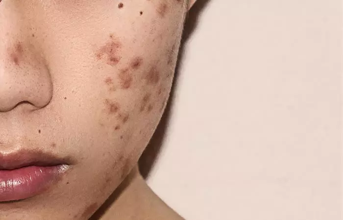 Each Kind Of Pimple Has A Different Cause 