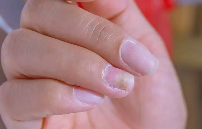 Brittle Fingernails