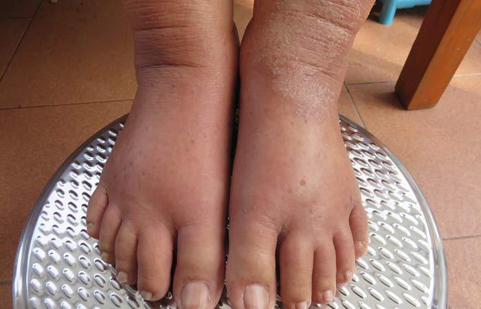 Is Swollen Ankles A Symptom Of Congestive Heart Failure