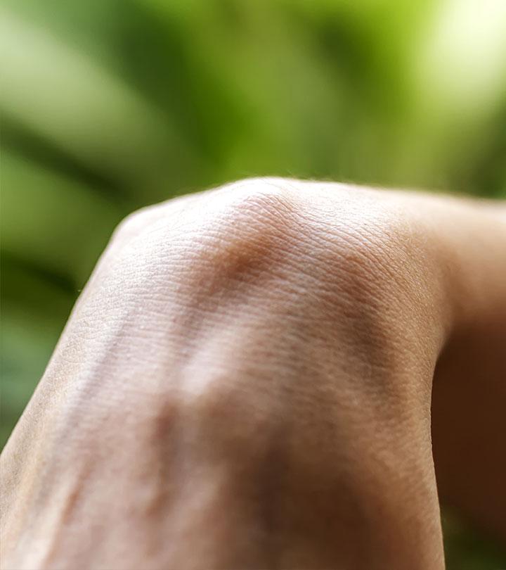 How Can I Get Rid Of A Ganglion Cyst On My Finger