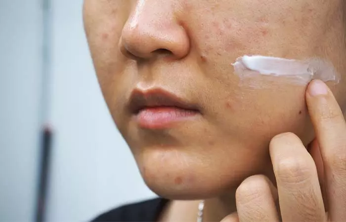 Say No To Hydrocortisone Cream