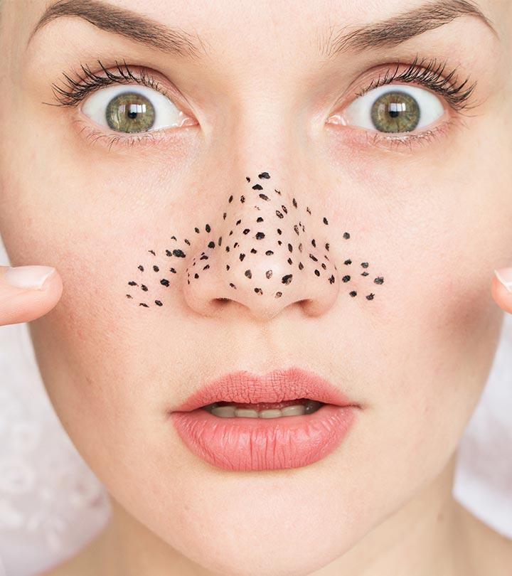 10 Best DIY Blackhead Removal Masks To Try