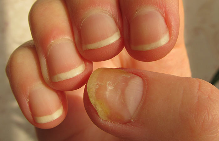 5. Nail Stains