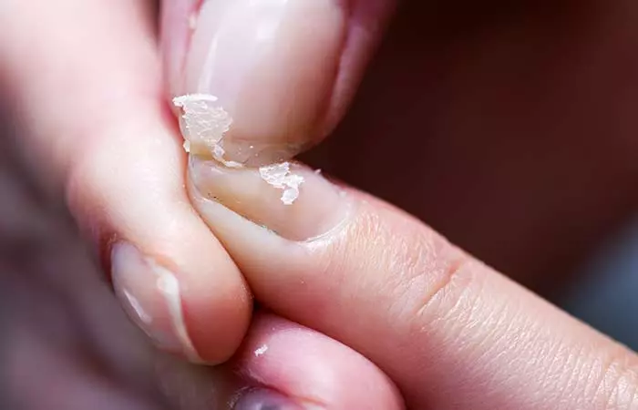 6. Brittle Nails