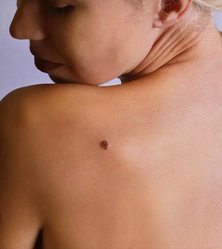 8 Dangerous Myths About Moles And Suntan That Even Some Doctors Seem To Believe In