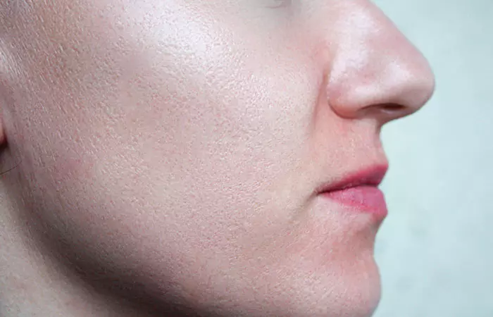 8. Large Pores