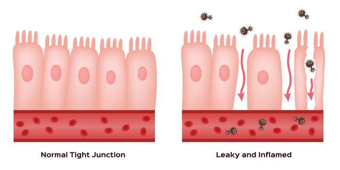 Heal Leaky Gut