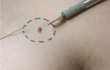 Myth Mole Removal With A Scalpel Is Outdated