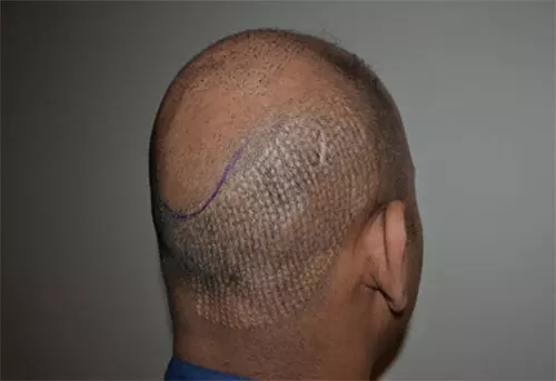 The Best Place To Get A Hair Transplant In India