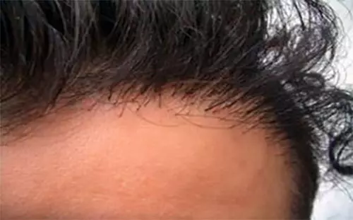 The Best Place To Get A Hair Transplant In India