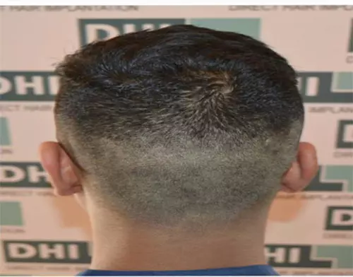The Best Place To Get A Hair Transplant In India