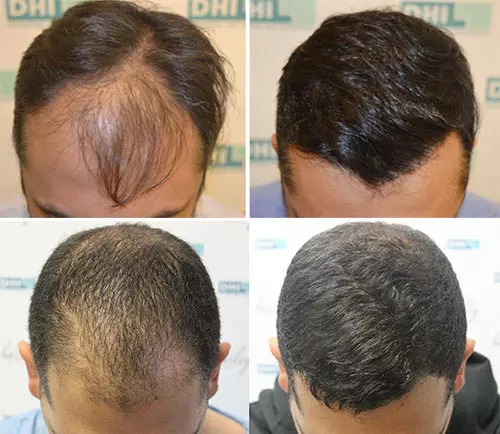 The Best Place To Get A Hair Transplant In India