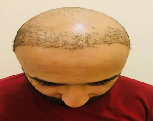 The Best Place To Get A Hair Transplant In India