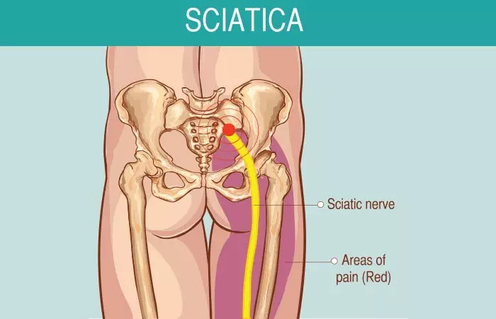 What Is Sciatica 