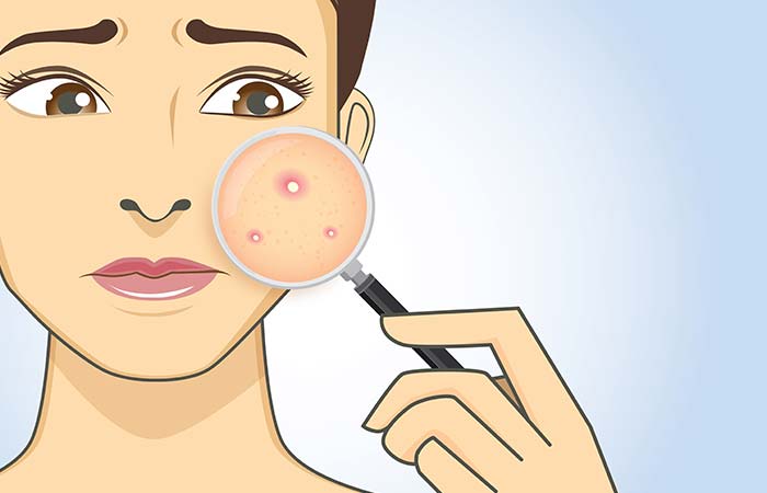 पिंपलमुंहासे हटाने के 20 घरेलू उपाय - Pimple Hatane Ke 20 Gharelu Upay - How to Remove Pimples at Home in Hindi